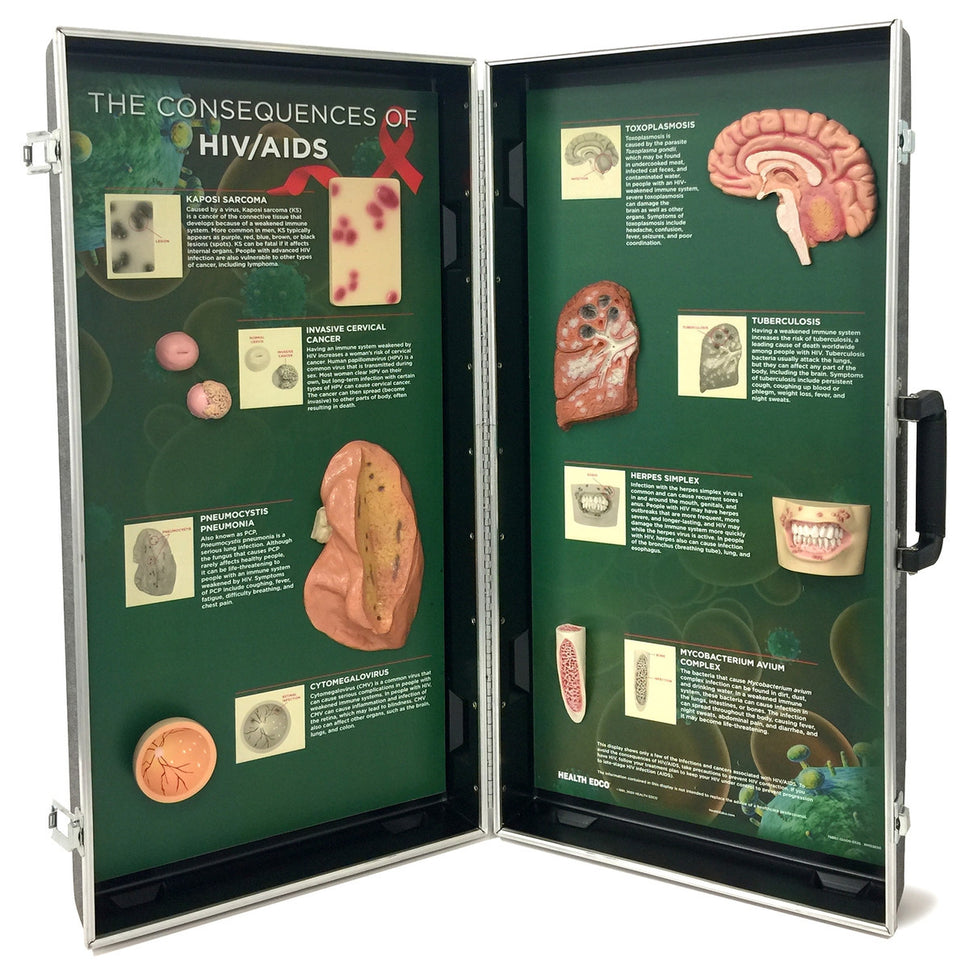 HIV/AIDS Consequences 3-D Display