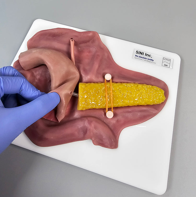 Pancreatojejunostomy Anastomosis Plate