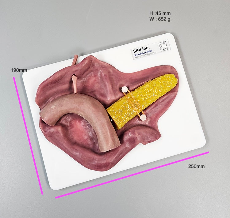 Pancreatojejunostomy Anastomosis Plate
