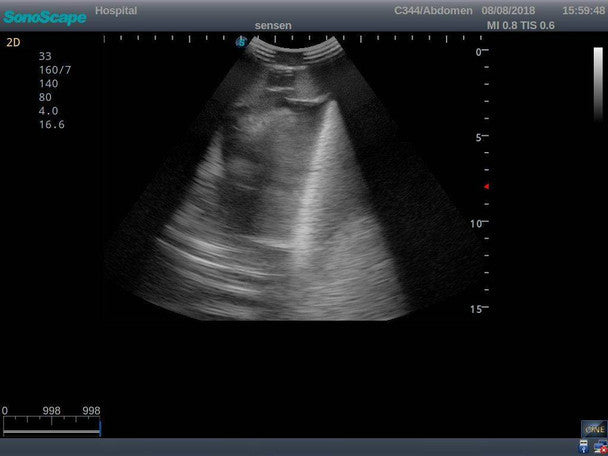 Pneumothorax and Thoracic Closed Drainage Ultrasound Training Model