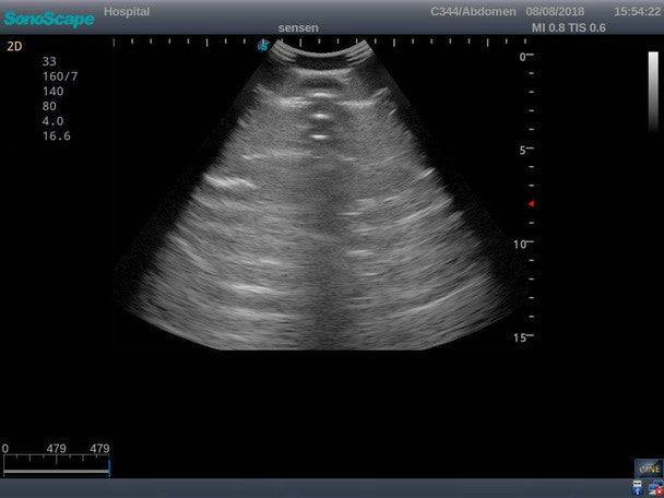 Pneumothorax and Thoracic Closed Drainage Ultrasound Training Model
