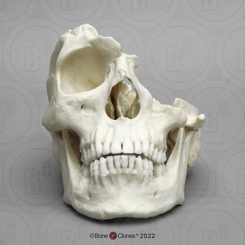 Bone Clones Forensic Trauma Skulls