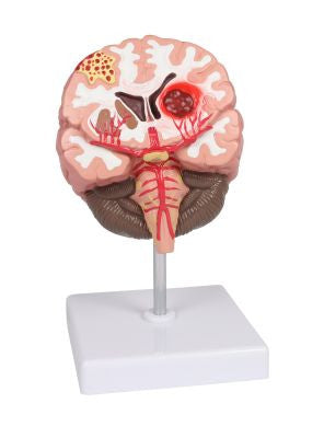 Brain Pathologies Anatomy Model