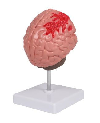 Brain Pathologies Anatomy Model