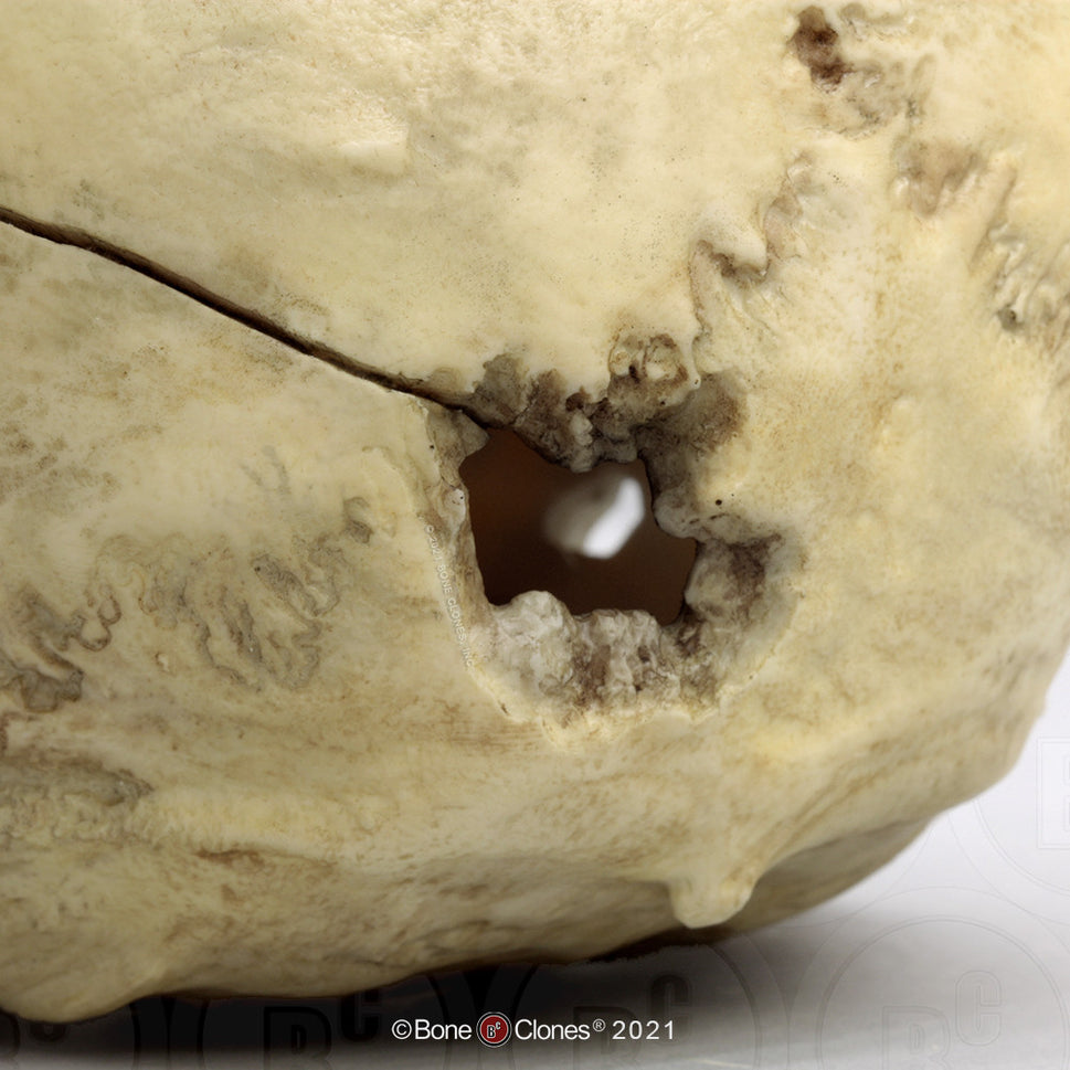 Bone Clones Forensic Trauma Skulls