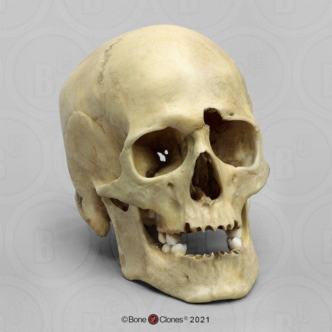 Bone Clones Forensic Trauma Skulls