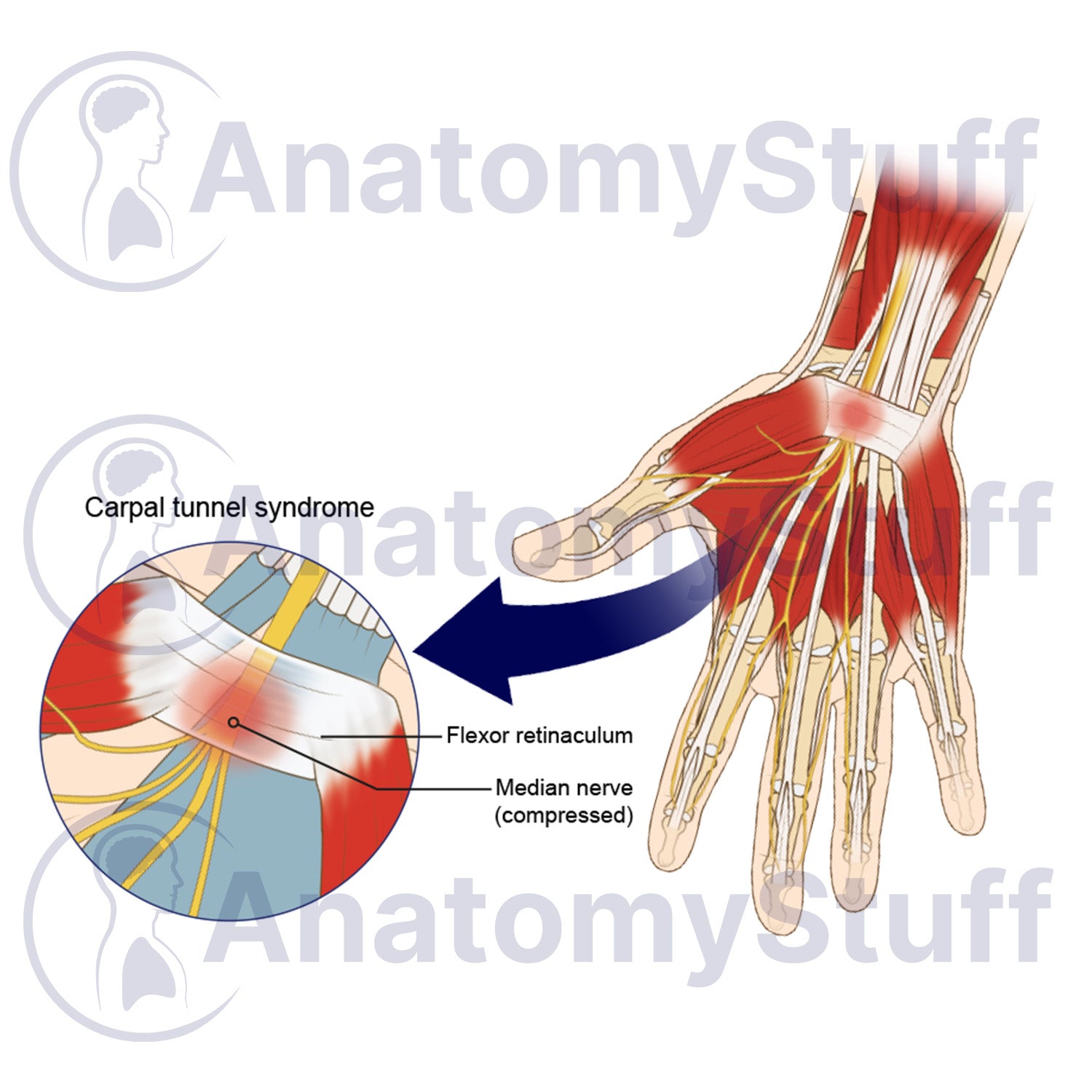 Carpal Tunnel Syndrome Illustration