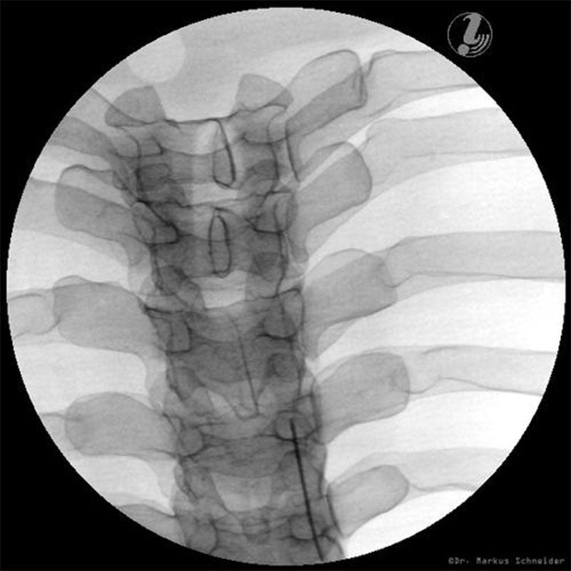 Thoracic Spine Injection Trainer