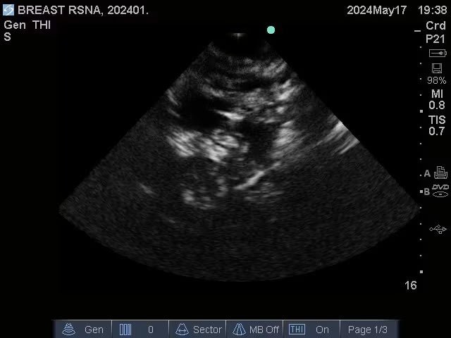 Adult Breast Phantom (Complex) for X-Ray CT, US, MRI