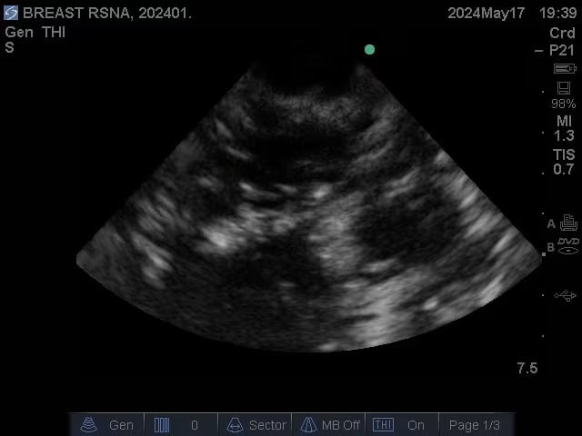 Adult Breast Phantom (Complex) for X-Ray CT, US, MRI