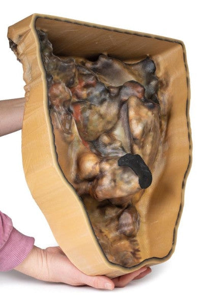 Posterior aspect of the abdomen with inguinal hernia model