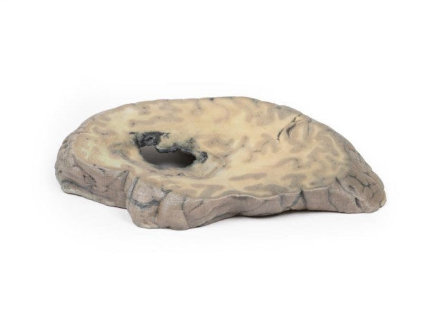 Cerebral Haemorrhage 3D Printed Anatomy Model