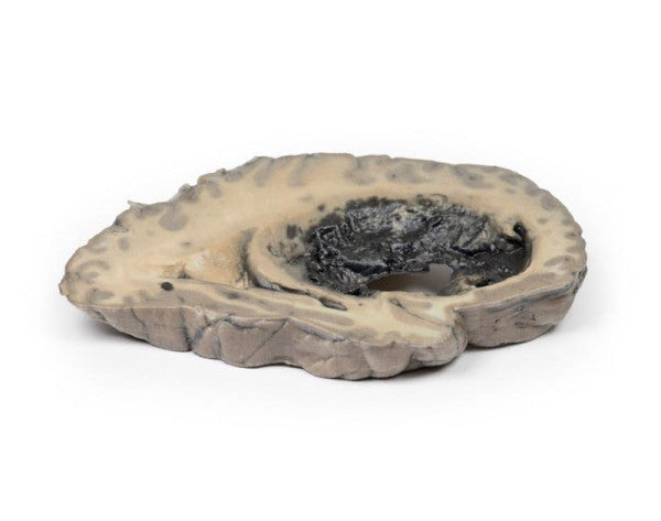 Cerebral Haemorrhage 3D Printed Anatomy Model