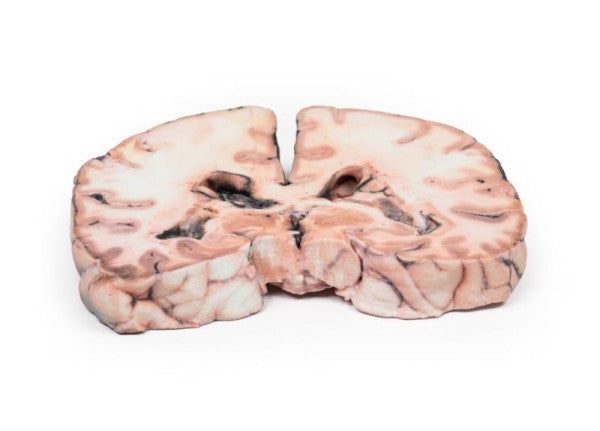 Glioma 3D Printed Anatomy Model
