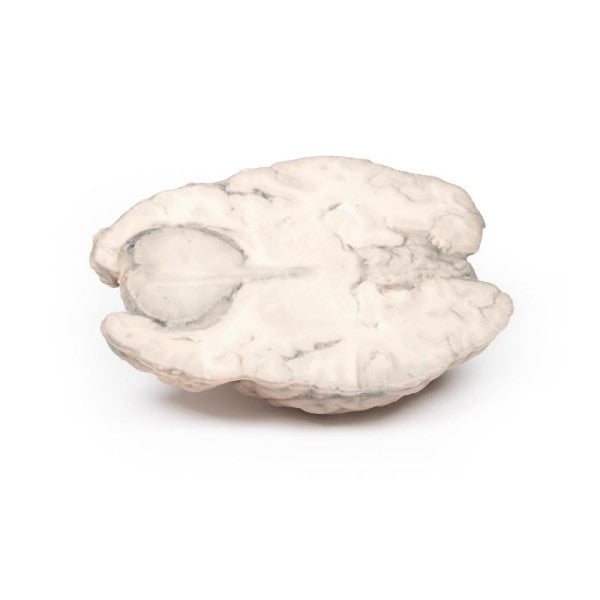 Brain Pathology 3D Printed Anatomy Model