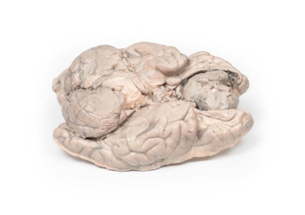 Brain Pathology 3D Printed Anatomy Model