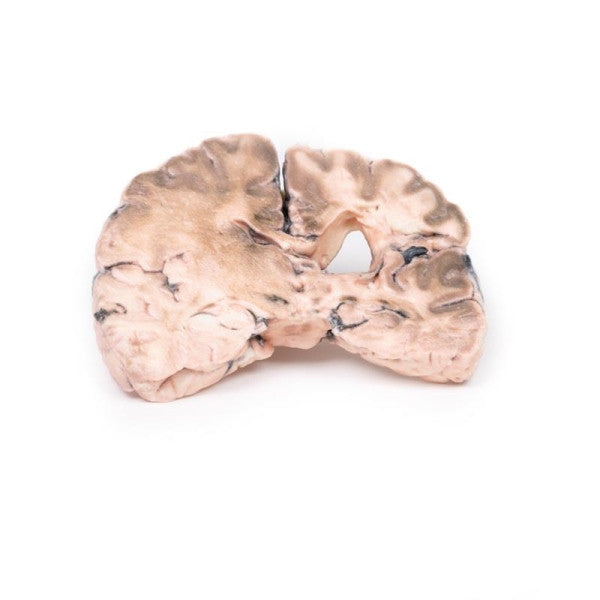 Brain Pathology 3D Printed Anatomy Model