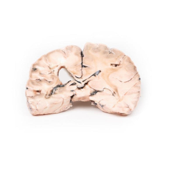 Brain Pathology 3D Printed Anatomy Model