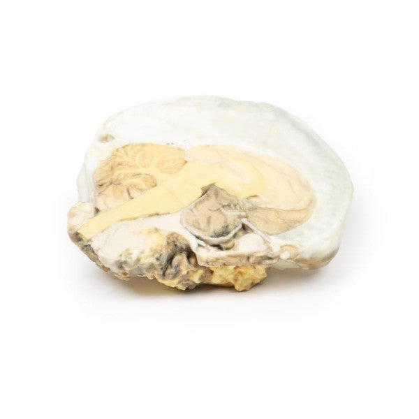 Adenoma 3D Printed Anatomy Model