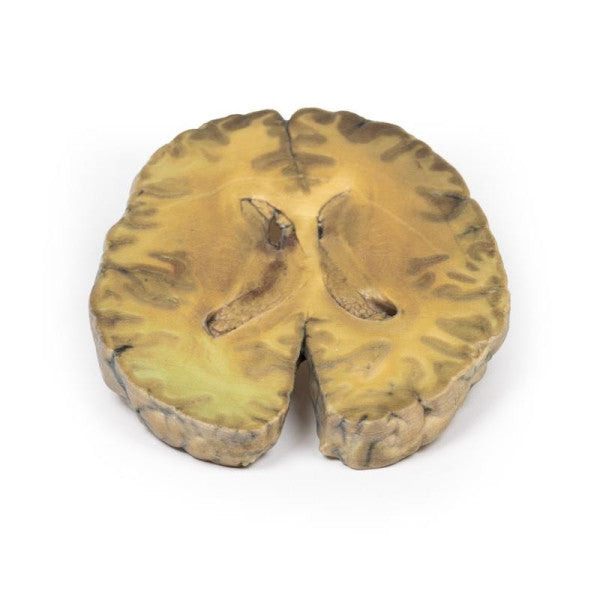 Brain Pathology 3D Printed Anatomy Model