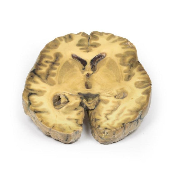 Brain Pathology 3D Printed Anatomy Model