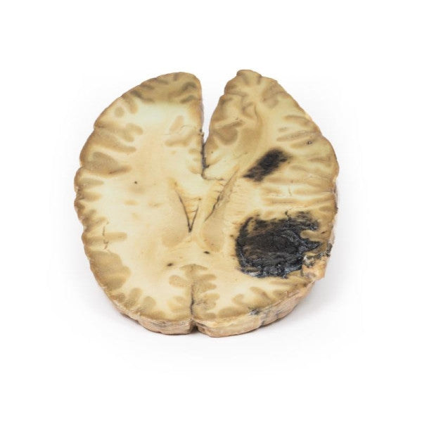 Cerebral Haemorrhage 3D Printed Anatomy Model