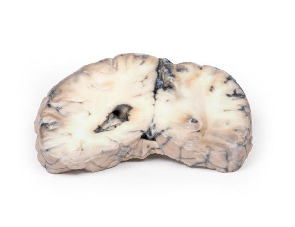 Brain Pathology 3D Printed Anatomy Model