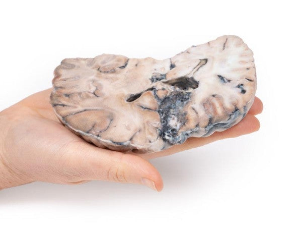 Brain Pathology 3D Printed Anatomy Model