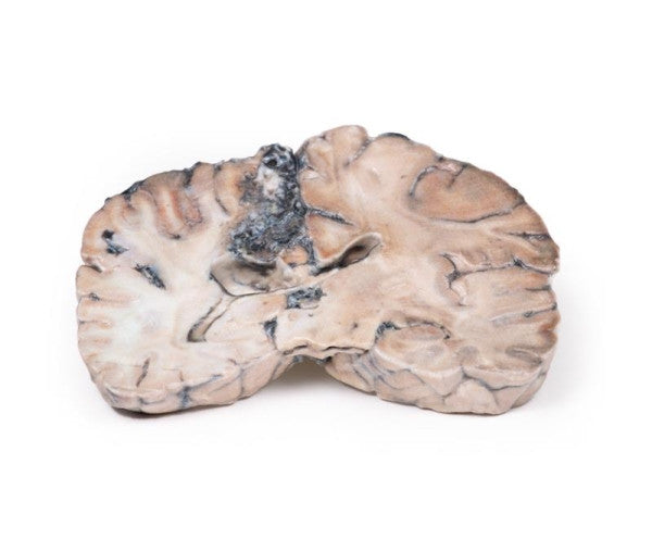Brain Pathology 3D Printed Anatomy Model