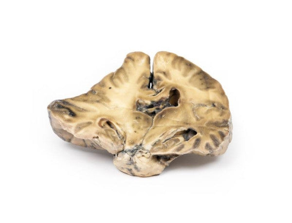 Brain Pathology 3D Printed Anatomy Model