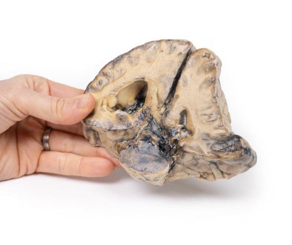 Brain Pathology 3D Printed Anatomy Model