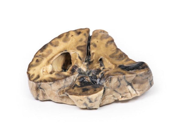 Brain Pathology 3D Printed Anatomy Model