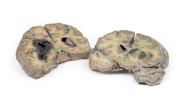 Brain Pathology 3D Printed Anatomy Model