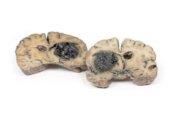 Brain Pathology 3D Printed Anatomy Model