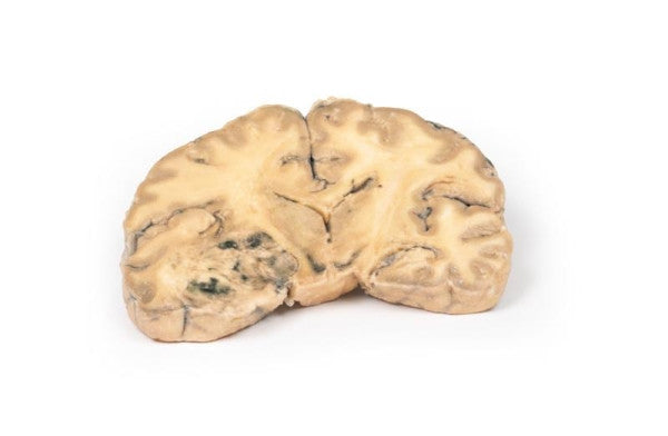 Brain Pathology 3D Printed Anatomy Model