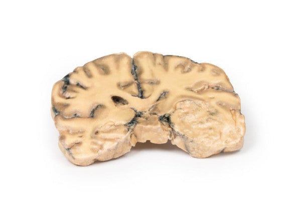 Brain Pathology 3D Printed Anatomy Model