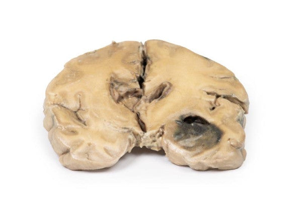 Glioma 3D Printed Anatomy Model
