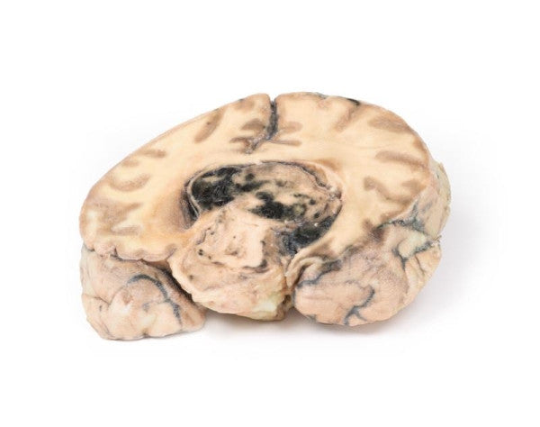 Glioma 3D Printed Anatomy Model