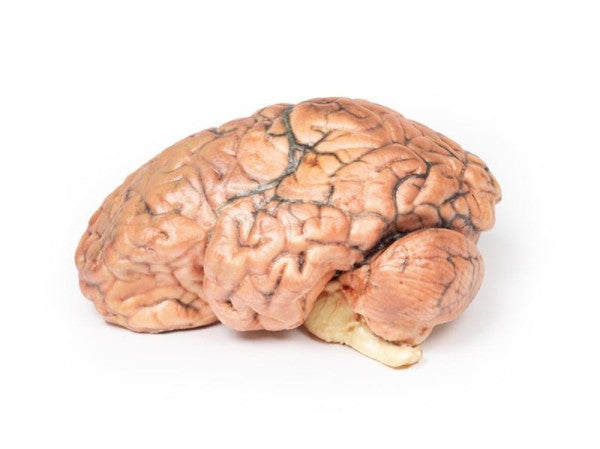 Brain Pathology 3D Printed Anatomy Model