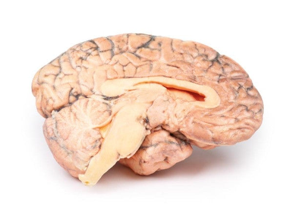 Brain Pathology 3D Printed Anatomy Model