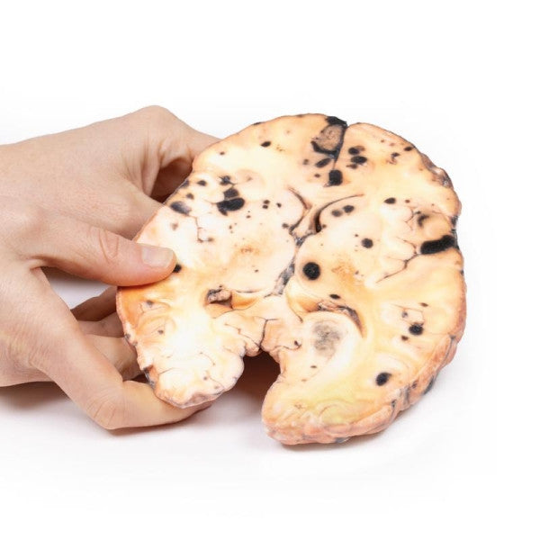 Melanoma 3D Printed Anatomy Model