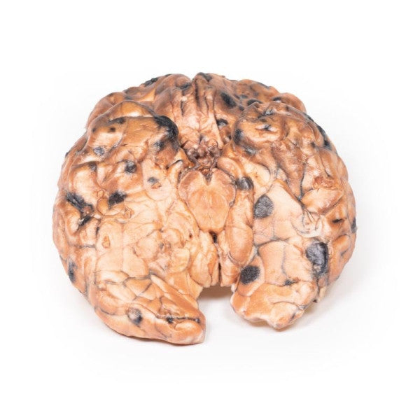 Melanoma 3D Printed Anatomy Model