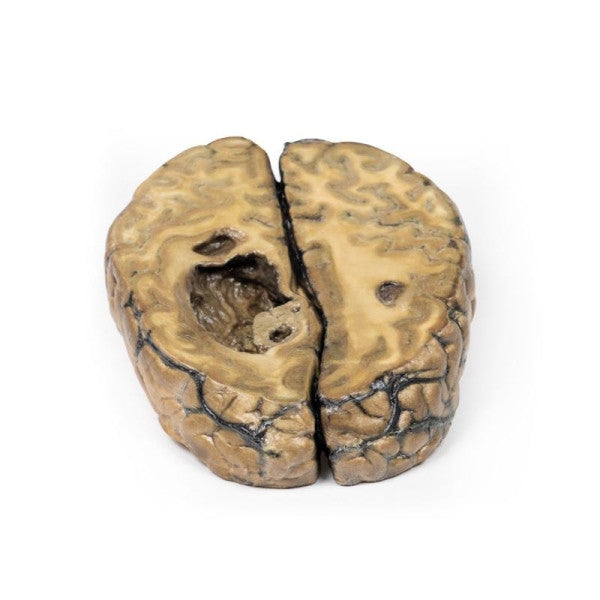 Carcinoma 3D Printed Anatomy Model