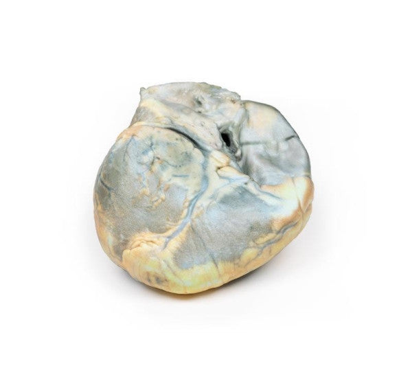 Posterior Aspect of the Right Ventricular Hypertrophy 3D Printed Anatomy Model