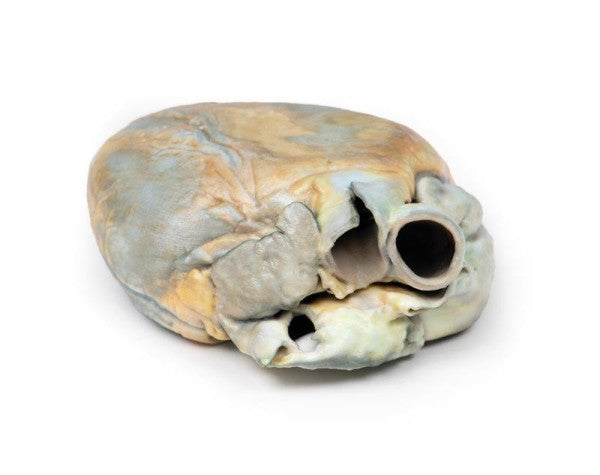 Superior View of the Right Ventricular Hypertrophy 3D Printed Anatomy Model