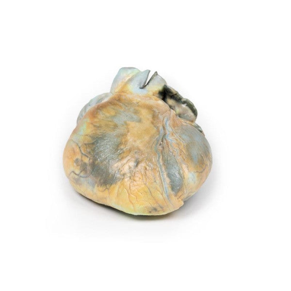 Right Ventricular Hypertrophy 3D Printed Anatomy Model