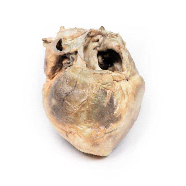 Posterior Aspect of the Atrial Septal Defect 3D Printed Anatomy Model