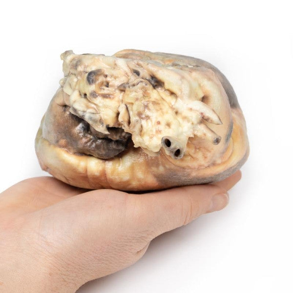 Superior Aspect of the Atrial Septal Defect 3D Printed Anatomy Model