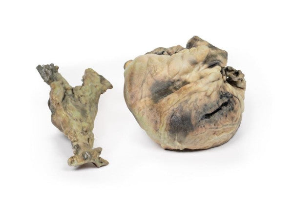 Posterior Aspect of the Hydatid Disease Affecting the Heart and Aorta 3D Printed Anatomy Model