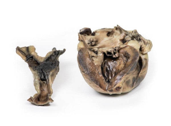 Hydatid Disease Affecting the Heart and Aorta 3D Printed Anatomy Model